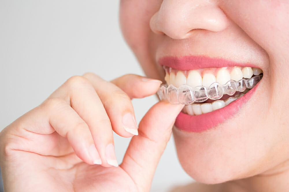 Invisalign Ballarat invisible braces treatment in ballarat