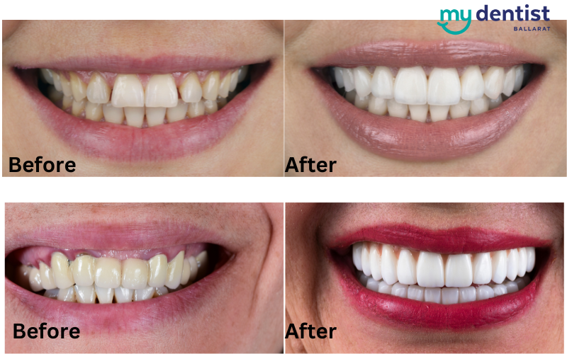 Benefits of Dental Veneers