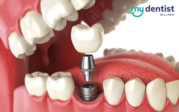 Dental Implants in Ballarat