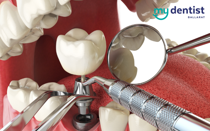 Understanding Dental Implants